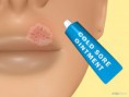 /album/fotogaleria/a670px-get-rid-of-a-cold-sore-step-1-jpg/