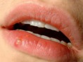 /album/fotogaleria/herpes-labialis-jpg/