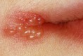 /album/fotogaleria/herpes-labial1-jpg/