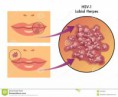 /album/fotogaleria/herpes-labial-25009805-jpg/
