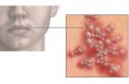 /album/fotogaleria/herpes-labial-jpg2/